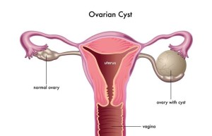 Female Health – Ovarian Cysts